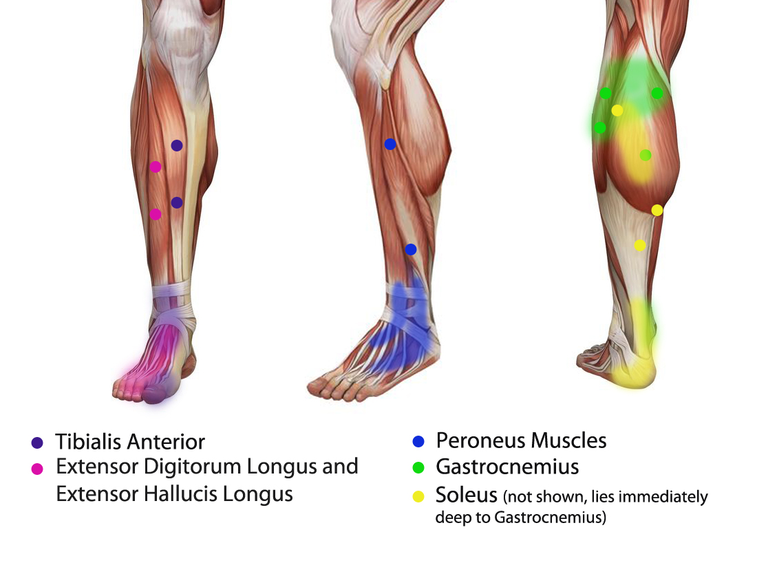 trigger points in the calf muscles