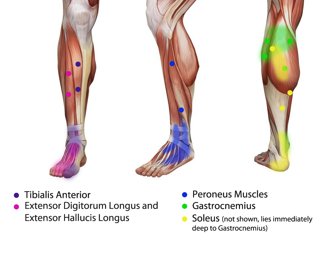 Sore calves 2025 after jumping rope