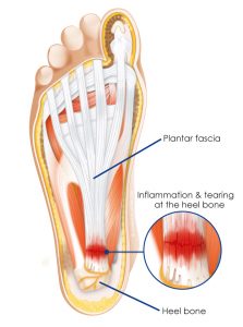 plantar fasciitis pain